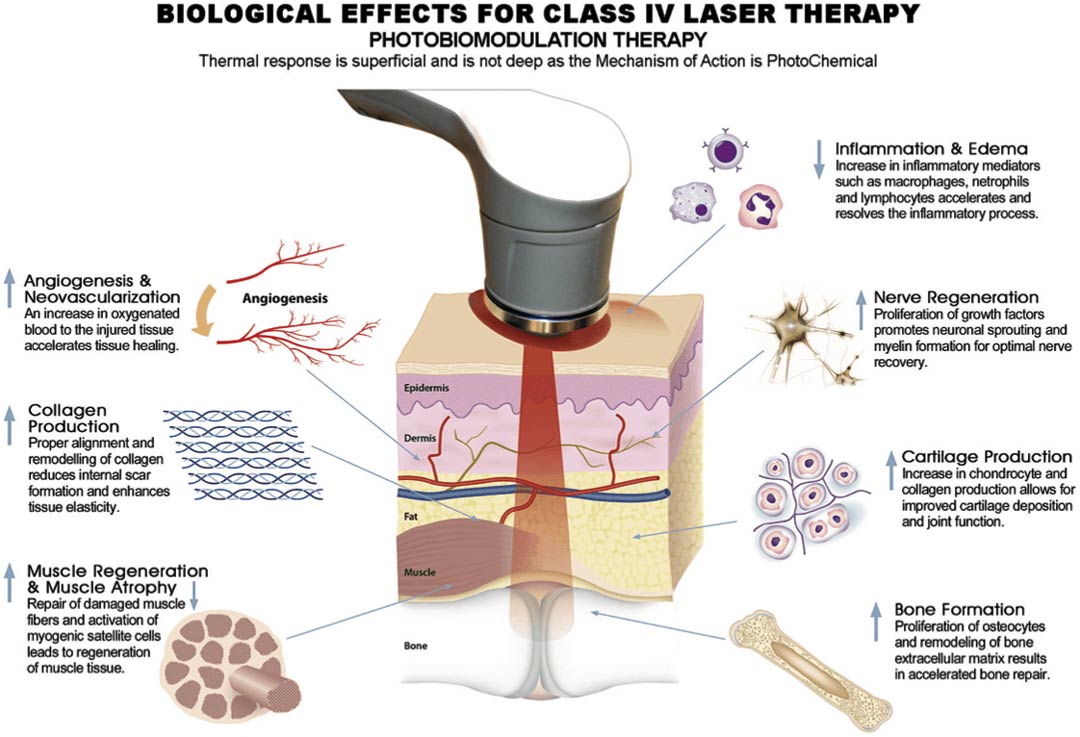 Diagram of how St Petersburg FL cold laser therapy works